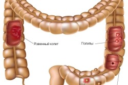 Заболевания кишечника