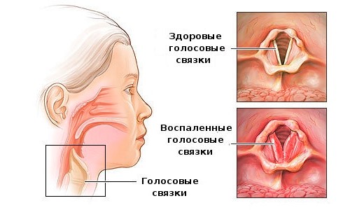 Схема ларингита