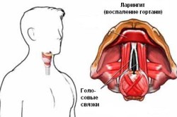 Ларингит - воспаление гортани