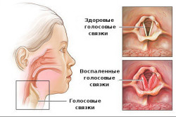 Голосовые связки при ларингите