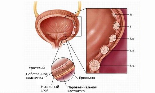 Схема лейкоплакии мочевого пузыря