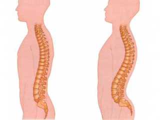 Слева - здоровый позвоночник, справа - лордоз поясницы