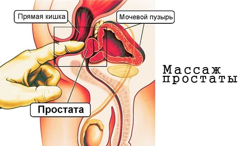 Сбор секрета проводится путем проведения массажа железы, который делают ректально