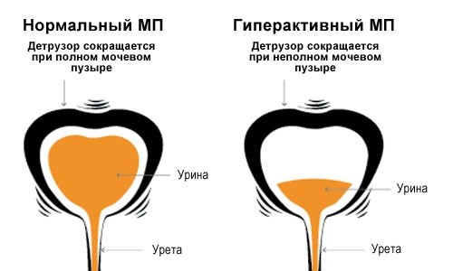 Схема гиперактивного мочевого пузыря