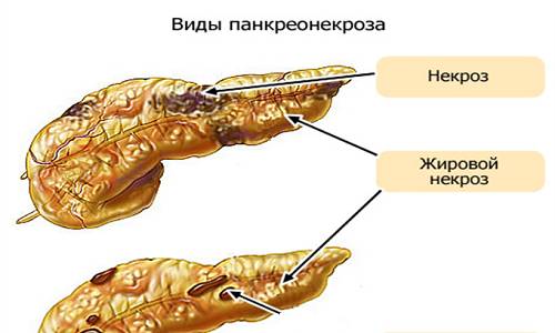 Опасность панкреатита заключается в том, что на тяжелых стадиях заболевания может возникнуть некроз поджелудочной железы