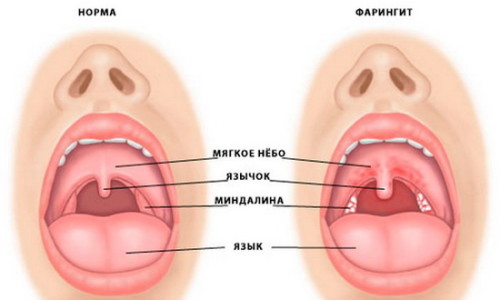 Проблема катарального фарингита
