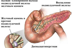 Схема панкреатита