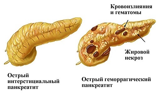 Острое течение панкреатита становится причиной отека серозной оболочки железы, катарального воспаления или некроза тканей органа