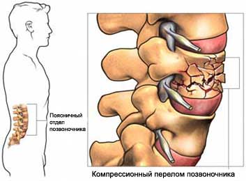 Компрессионный перелом в поясничном отделе