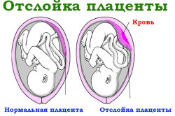 Отслойка плаценты - следствие гипотиреоза 