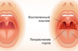 Признаки ангины