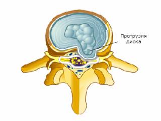 Что такое протрузия диска