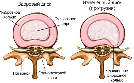 Протрузия - выбухание межпозвоночного диска