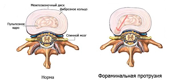 Протрузия - начальная стадия грыжи межпозвоночного диска