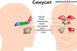 Частые синуситы-причина хронического тонзиллита