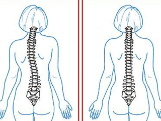 сколиотическая осанка