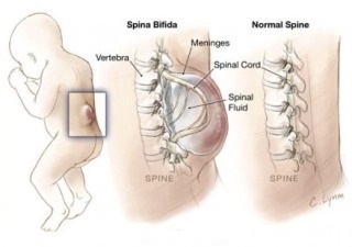 Как проявляется спина бифида