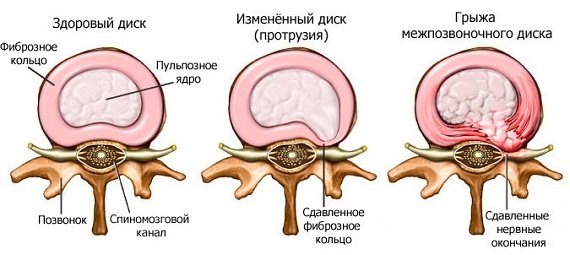 Схема образования спинной грыжи