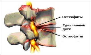 Результат спондилеза - остеофиты