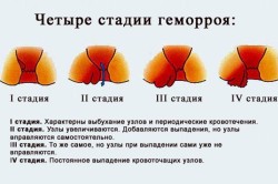 Стадии геморроя