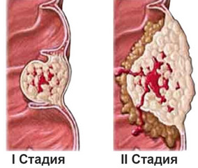 стадии рака