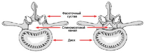 Позвоночный канал в норме и пораженный стенозом