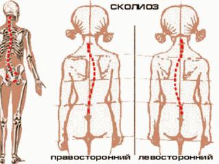 Сутулость ведет к развитию сколиоза