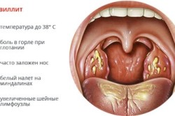 Симптомы хронического тонзиллита