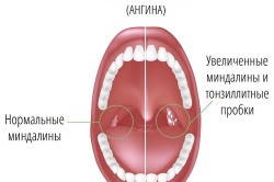 Острый тонзиллит