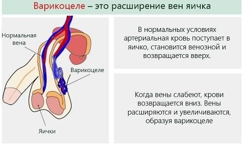 Влияние варикоцеле на потенцию может быть прямым и косвенным