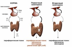 Виды гипотиреоза