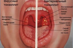 Виды тонзиллита