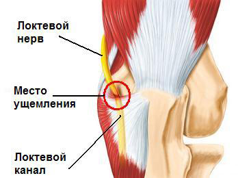 Как происходит защемление