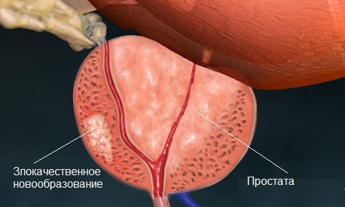 Гормонозависимым раком простаты называется злокачественная опухоль, развивающаяся на фоне нарушения синтеза тестостерона